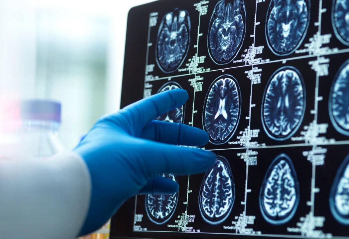 Could This Brain Protein Be the Key to Combating Alzheimer's?
