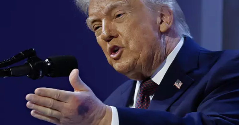 Trump clarifies the cause of bruise on hand following new pictures that raised concerns.