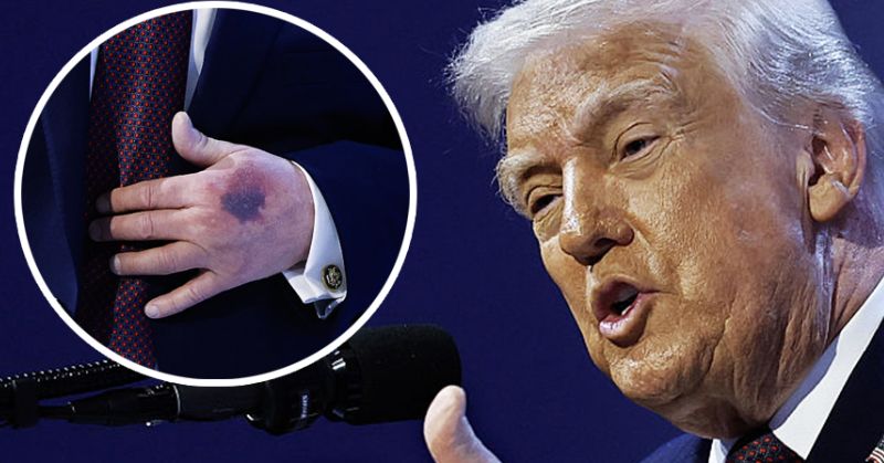 Trump clarifies that his visible hand bruise is the result of a minor accident with a table.