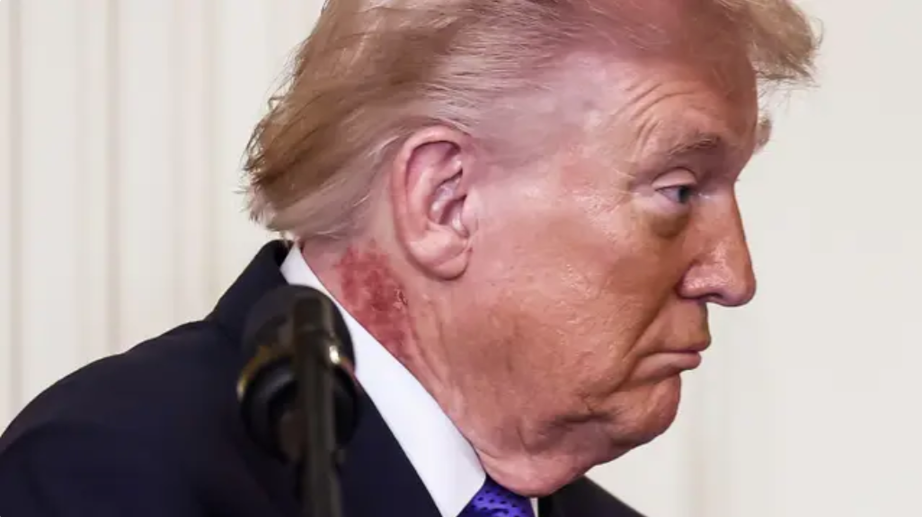 Donald Trump's Neck Rash Raises New Health Worries
