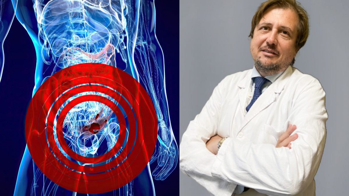Tumore al colon-retto: incidenza in aumento tra i giovani adulti nei paesi occidentali