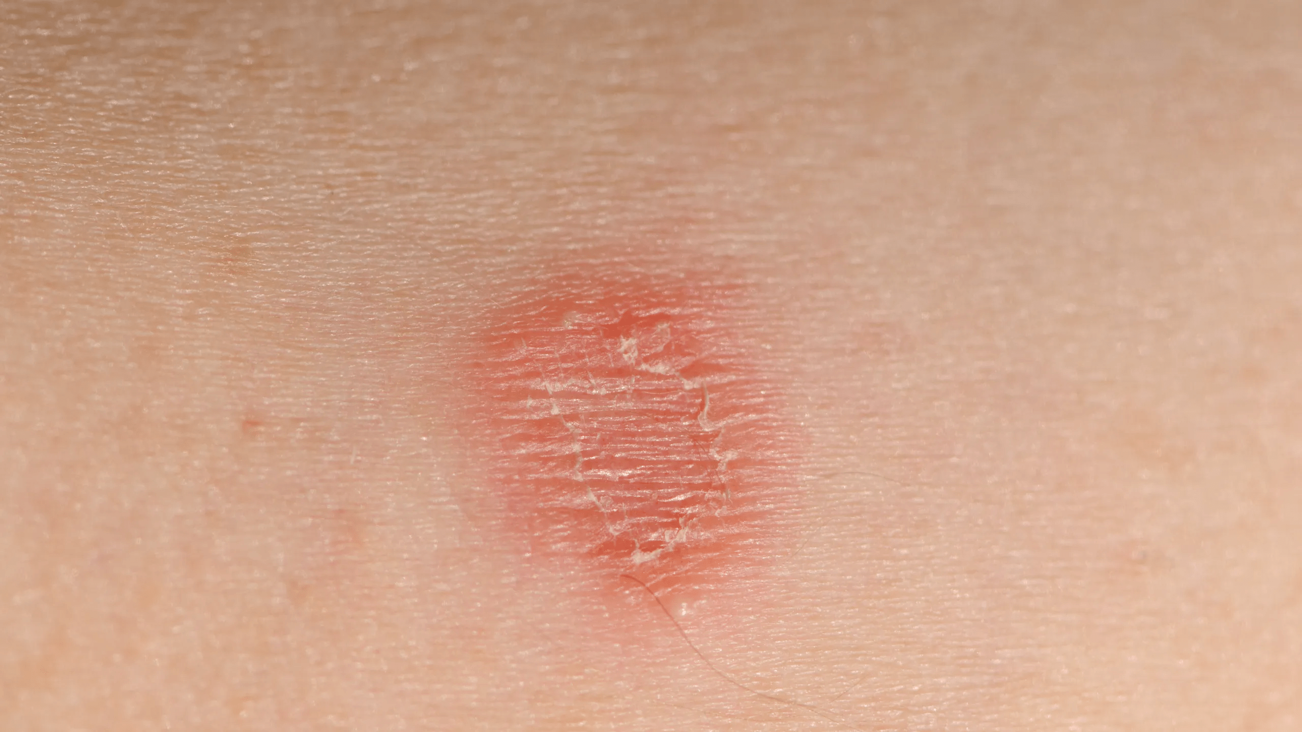 Minnesota Becomes Ground Zero for Rare STD Outbreak