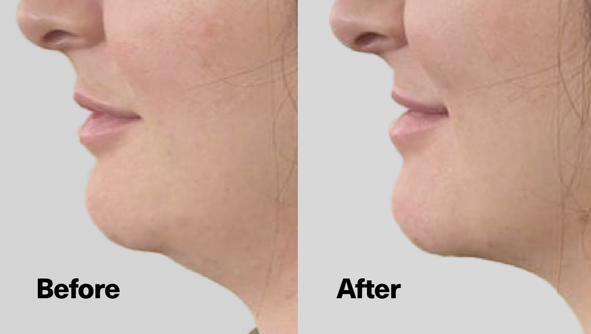 Get Rid of Double Chin with This Jawline-Enhancing Serum!