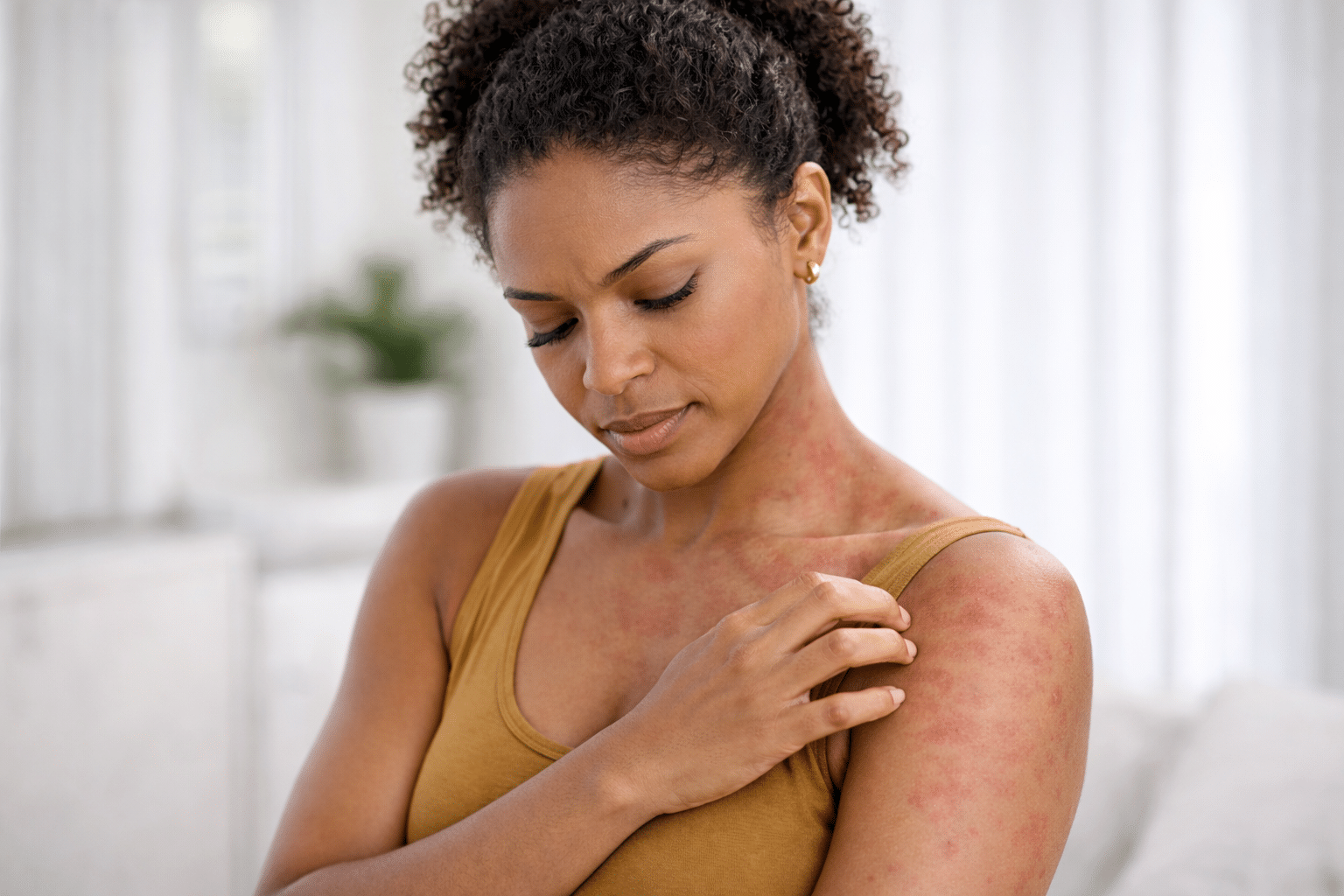 Allergist Reveals Surprising Facts About Mysterious Hives