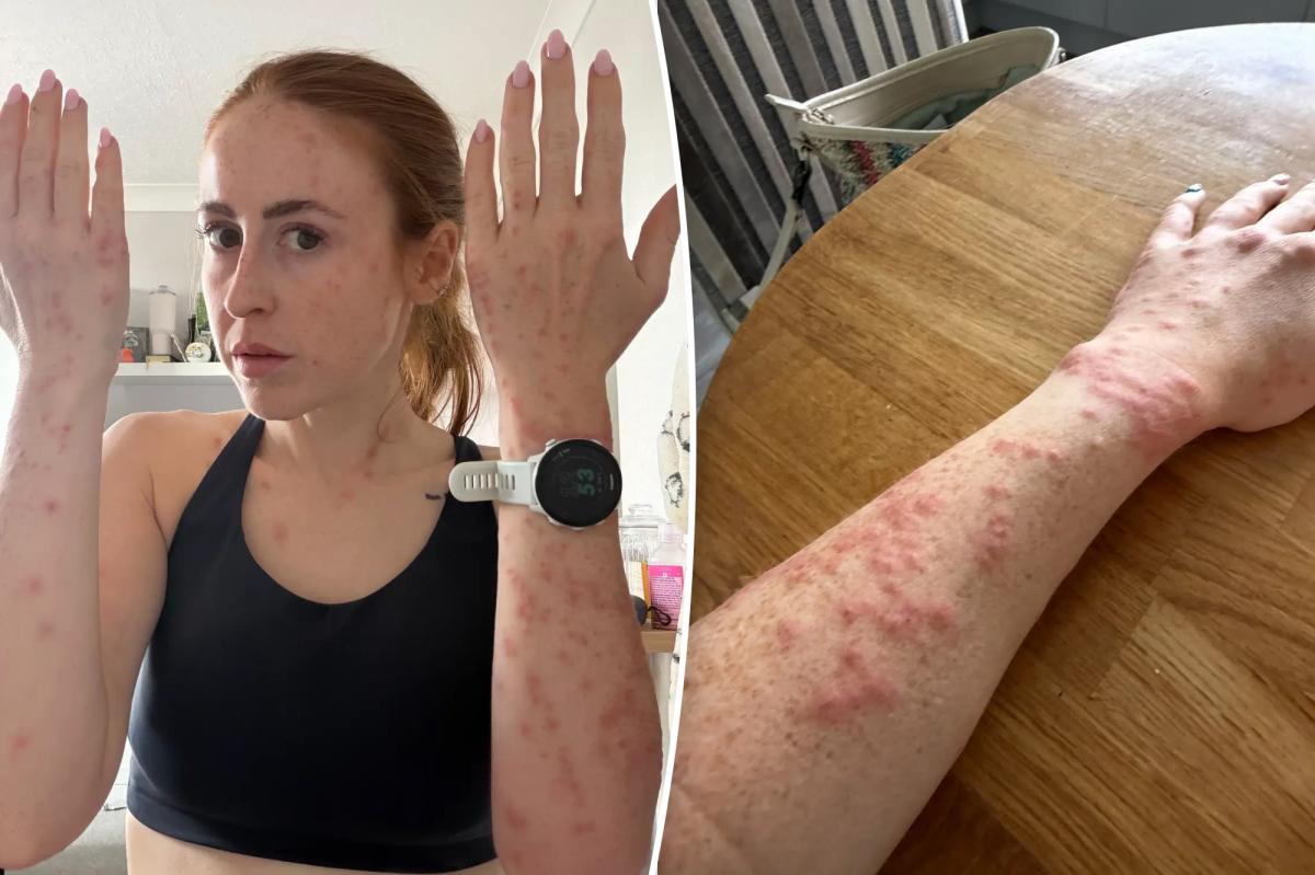 Travel Influencer's Bedbug Nightmare at UK Hotel Sparks Outrage